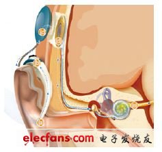圖5,植入耳蝸將聲音轉(zhuǎn)換為電脈沖，送給聽覺神經(jīng)。話筒將聲音捕捉給聲音處理器（a）。聲音處理器將聲音轉(zhuǎn)換為詳細(xì)的數(shù)學(xué)信息 （b）。