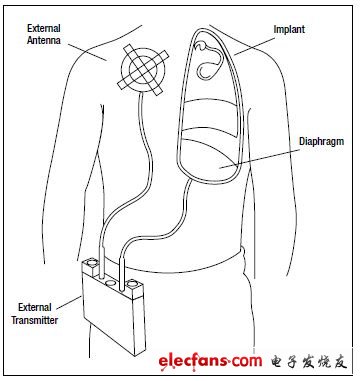 圖7,呼吸起搏器帶有用于膈神經(jīng)刺激的植入電極以及RF接收器，還有向植入體發(fā)射RF信號的外部天線，完成刺激起搏功能