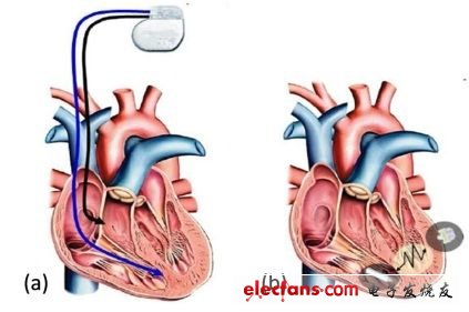 收集來自心跳的振動能量