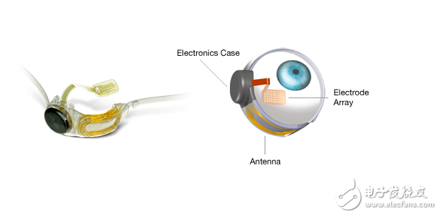 Argus II仿生眼，幫助盲人重見光明!