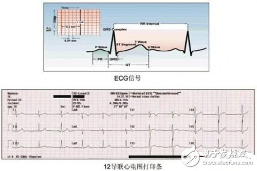 利用ECG AFE簡化病人監(jiān)護儀設計